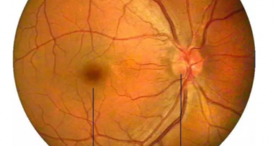 叶黄素是防止黄斑病变致老年失明的“视黄金”--验光师培训科普