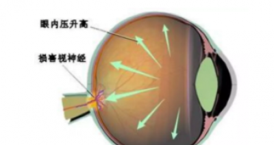 验光师培训中老年人如何预防青光眼