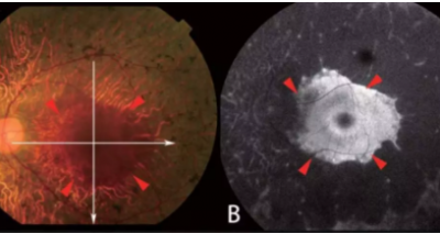 眼视光最新研究：后巩膜葡萄肿不一定是高度近视