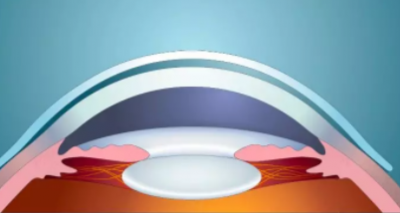 【眼视光研究】巩膜镜帮助角膜病患者提升视觉质量