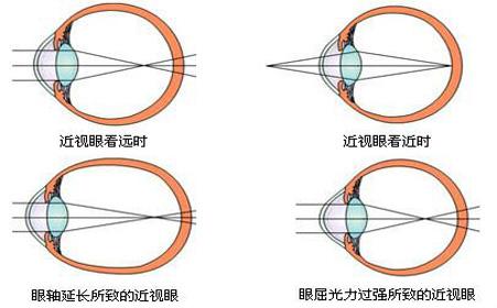 近视是怎样形成的？视普泰验光师培训学院带您走进了解