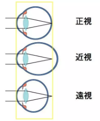 角膜塑形镜