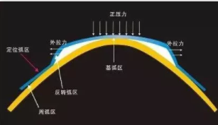 角膜塑形镜