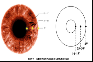 斜弱视