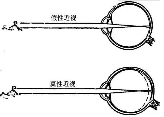 散瞳验光