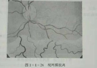 初级验光师培训知识点：影响视觉的原因分析