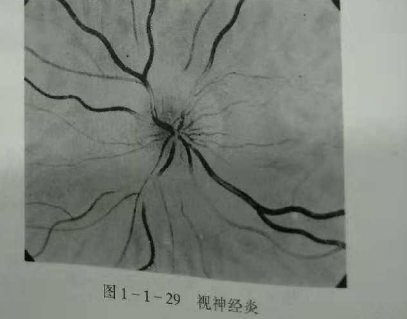 初级验光师培训知识点：影响视觉的原因分析