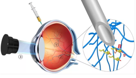 美《Science》杂志：有眼疾，让小小小机器人游进眼睛帮你上药