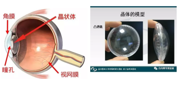 眼科专家赵娟：家长如何自查孩子有没有先天性白内障