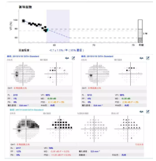 温医大梁远波教授：大部分失明青光眼患者因就诊不及时所致 | 世界青光眼日