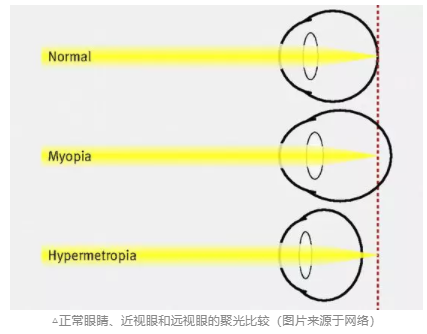 探讨青少年近视与电子屏幕关系，近视关联强因素详细分析