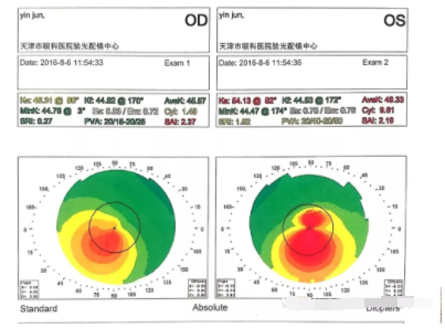 眼视光行业分享圆锥角膜验配RGP经验