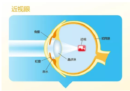 深圳验光师培训近视一定会遗传吗？