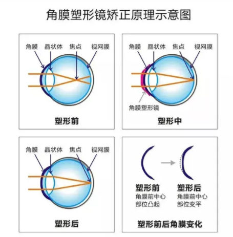 验光师带您了解角膜塑形镜的来龙去脉