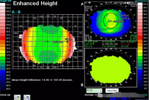 高度近视患者配戴角膜塑形镜的效果观察