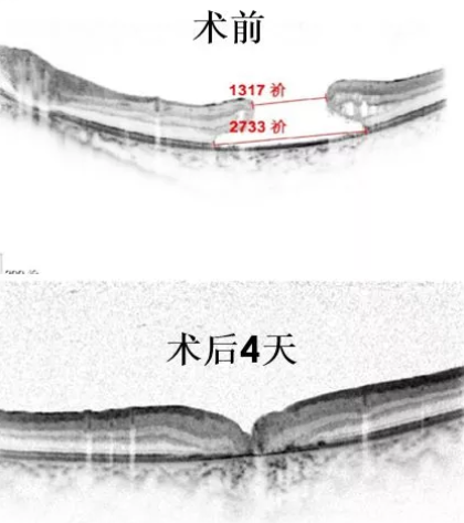 11岁患儿因激光笔损害视网膜造成罕见巨大黄斑裂孔，温医大眼视光成功治愈