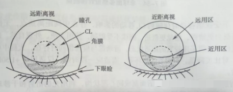 天津市眼科医院视光中心张姝贤主任：多焦点软性接触镜矫正老视的验配要点