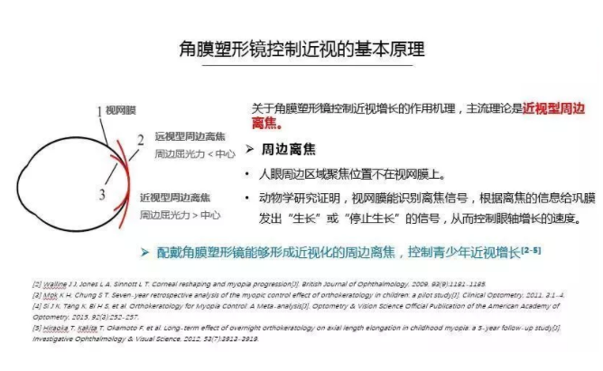 【眼视光前沿】一种具有非球面基弧设计的角膜塑形镜