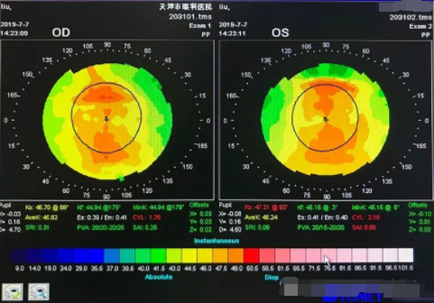 眼视光行业案例分享：适合高度近视的软性隐形眼镜