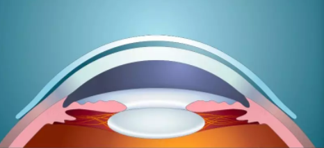 【眼视光研究】巩膜镜帮助角膜病患者提升视觉质量